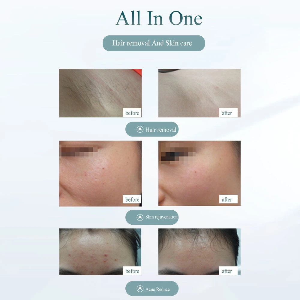 Painless IPL Hair Removal Device